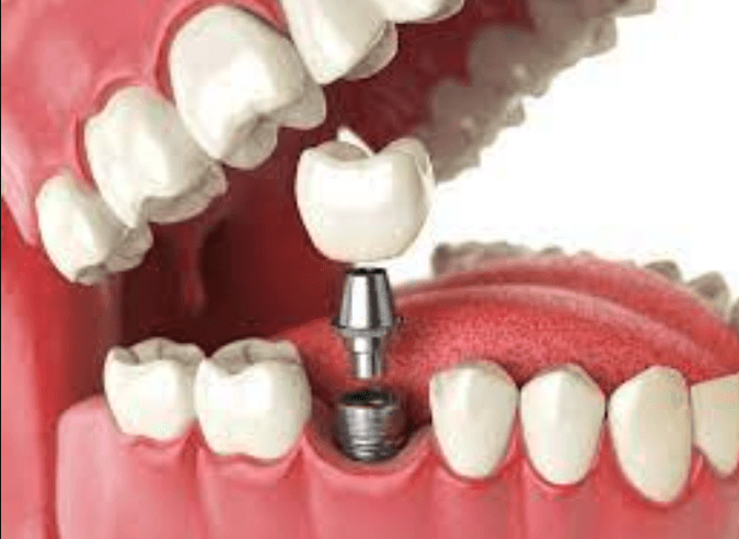 Benefits of getting dental implants