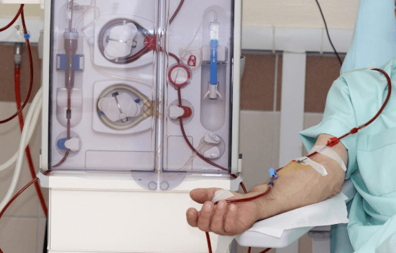 What to Expect When Undergoing Dialysis Treatment